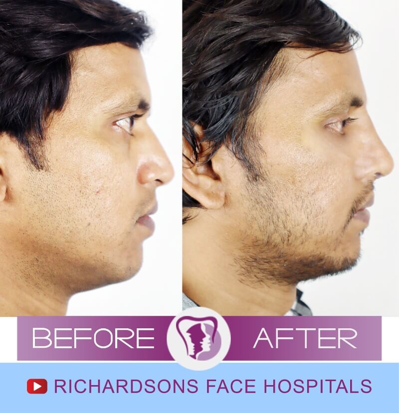 Rhinoplasty Surgery Raju