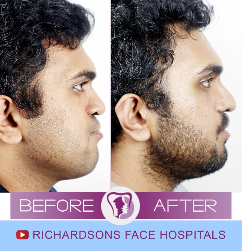 Cleft Lip Palate Surgery Venkateswara