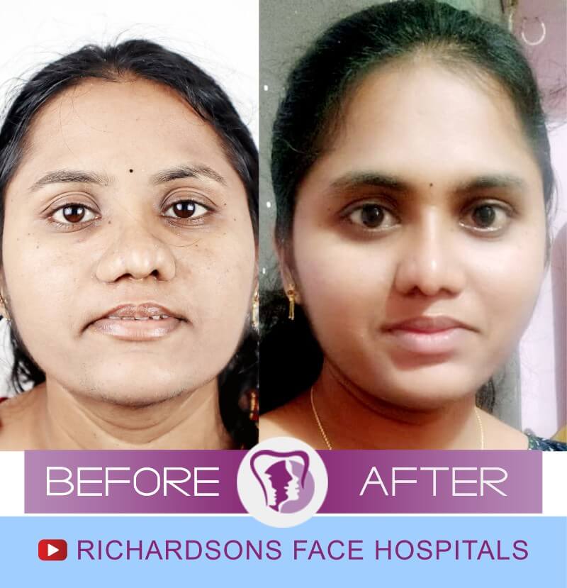 Dasari Bhavana Rhinoplasty Surgery