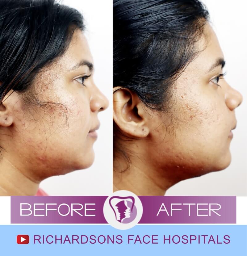 Facial Asymmetry Surgery Karthika