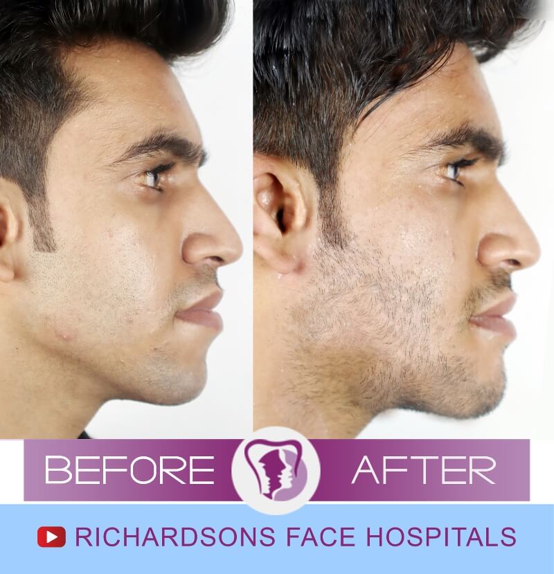 Facial Asymmetry Surgery Ritish Soni
