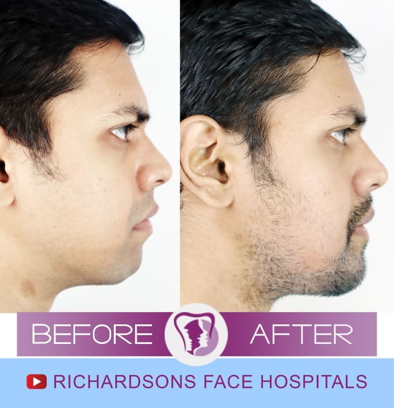 Facial Asymmetry Surgery Tousif
