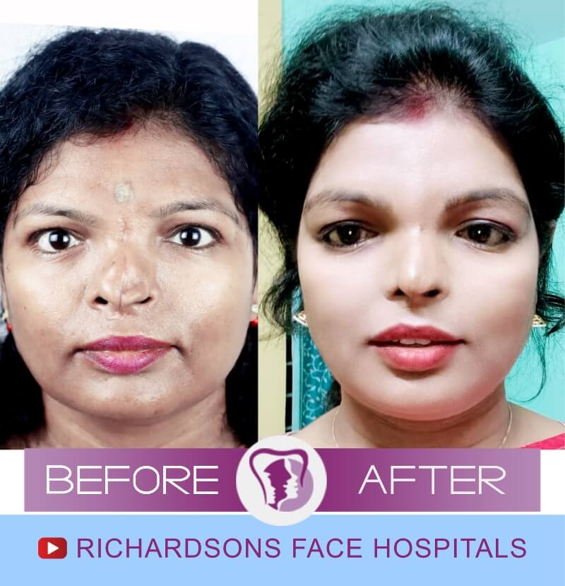 Gauri Kumari Septo Nose Surgery