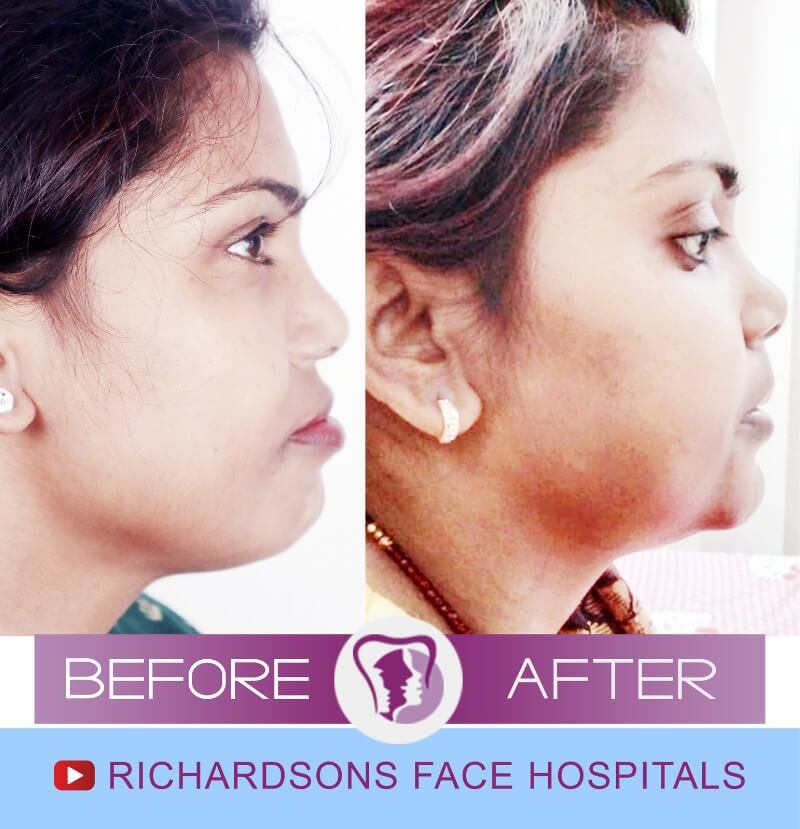 Jaw Surgery Suman Devi