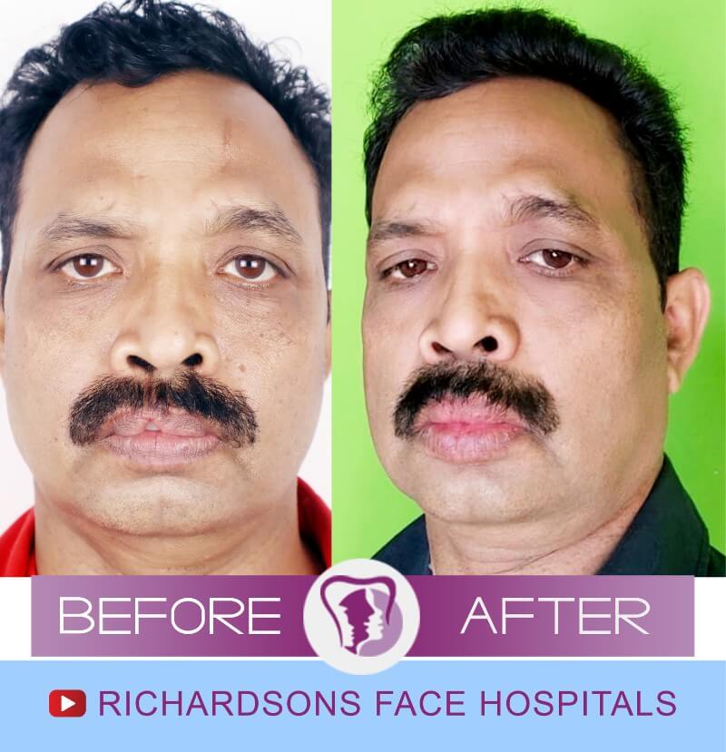 Jayanta Das Lip Revision Surgery