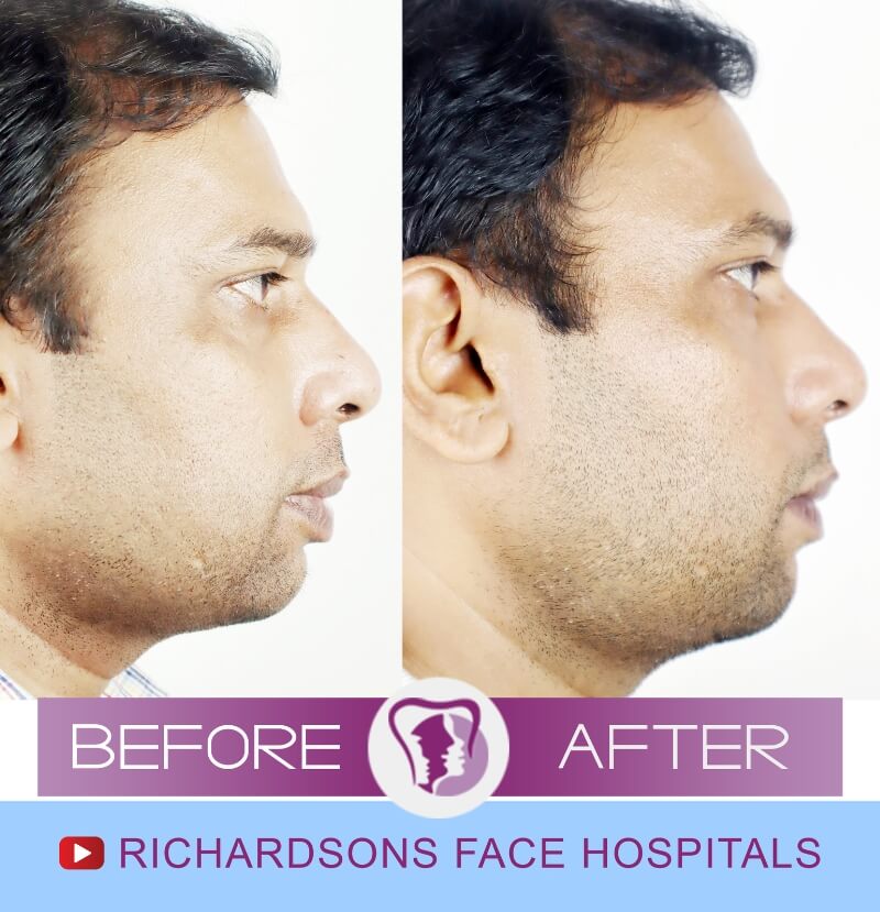 Lip Reduction Surgery Sandip