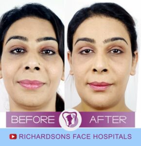 Mannat Face Makeover Surgery