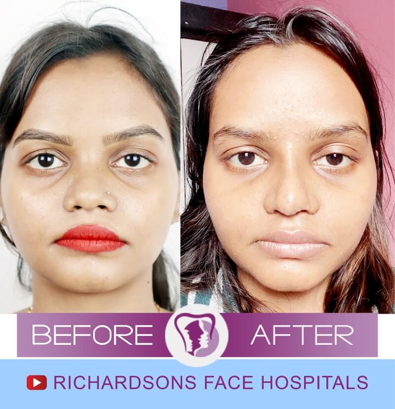 Monika Nose Surgery
