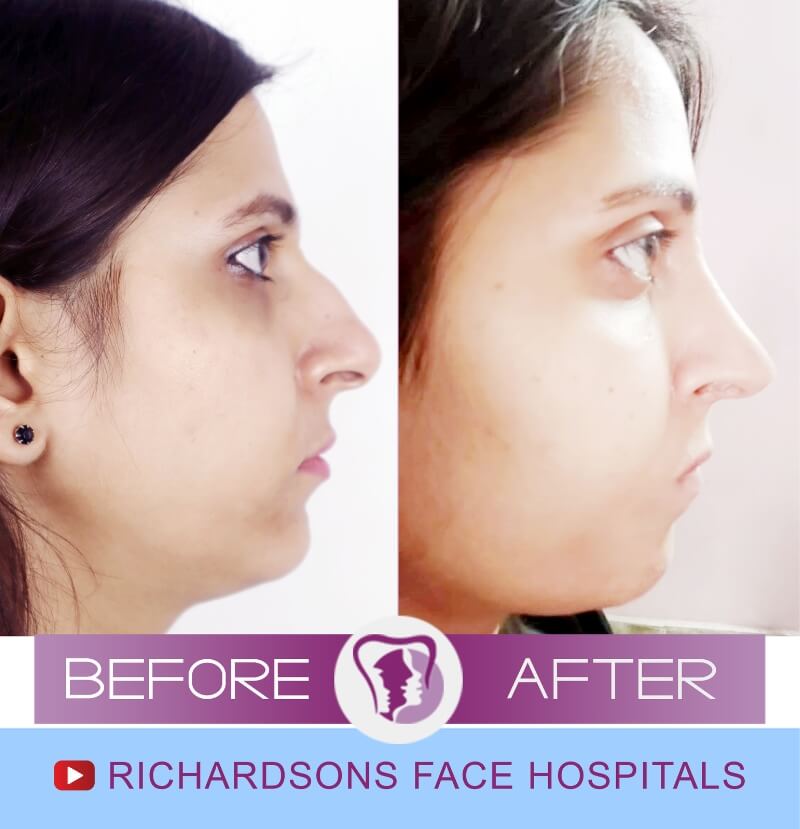 Nose Surgery Sakshi