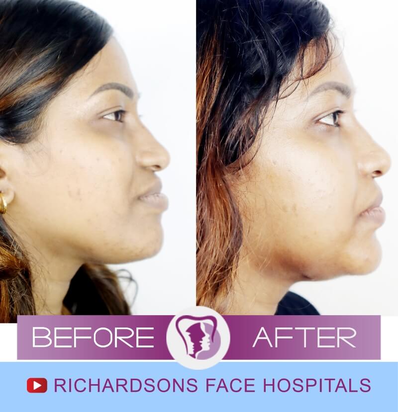Nose Surgery Shilpa