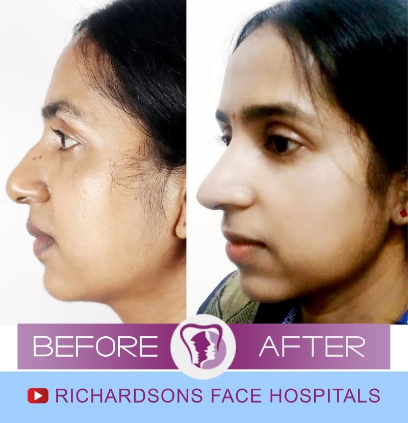 Rhinoplasty Surgery Sunitha