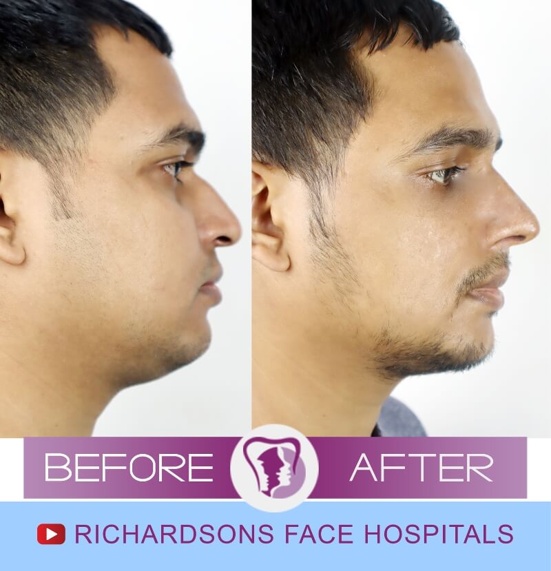 Rhinoplasty Surgery Vishal Shravan
