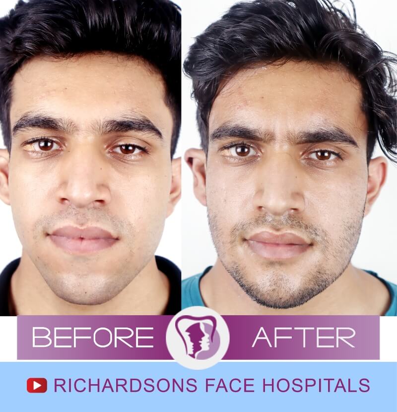 Ritish Soni Facial Asymmetry Surgery