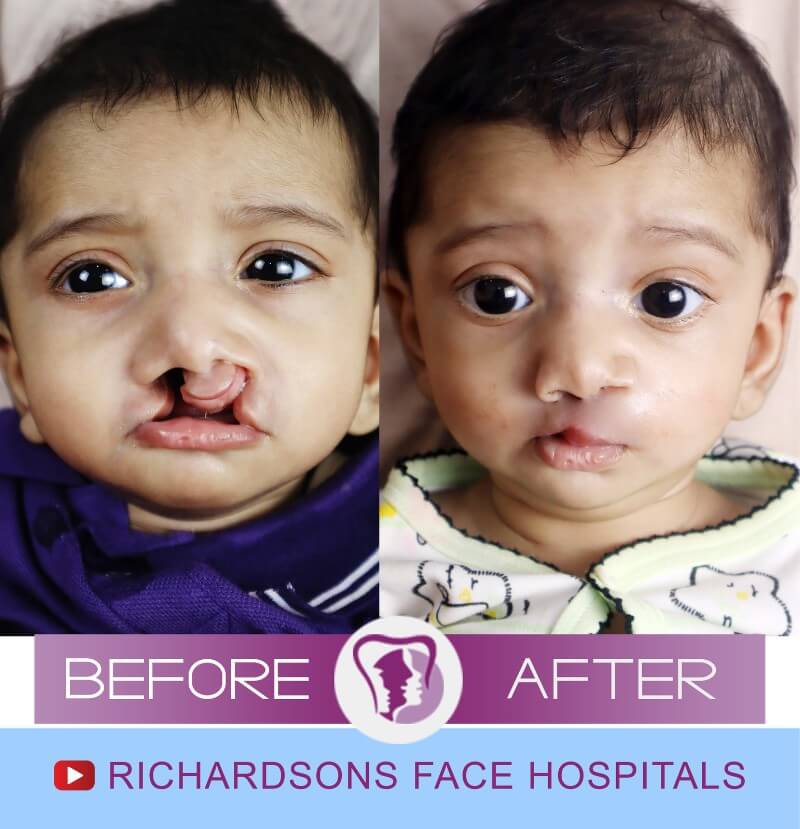 Rudraksh Cleft Lip Palate Surgery