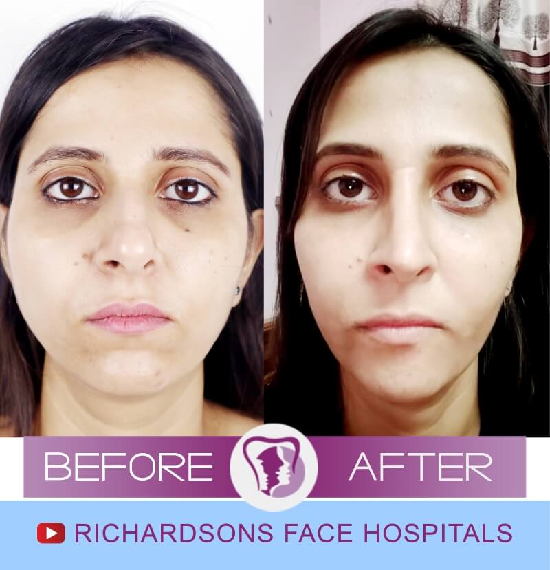 Sakshi Nose Surgery