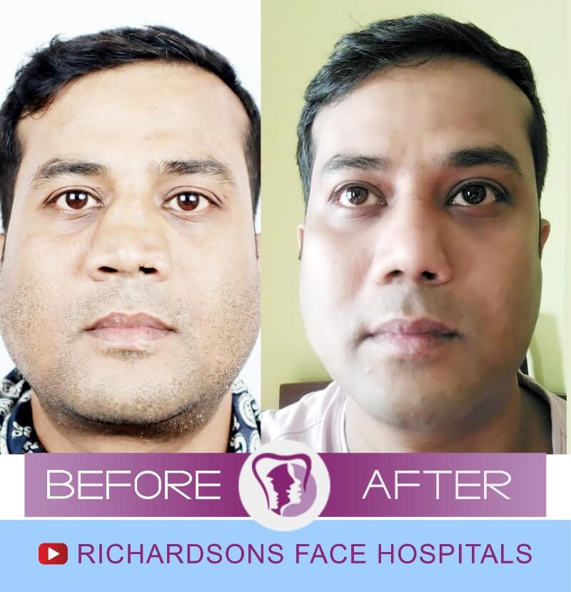 Samrat Roy Rhinoplasty Surgery