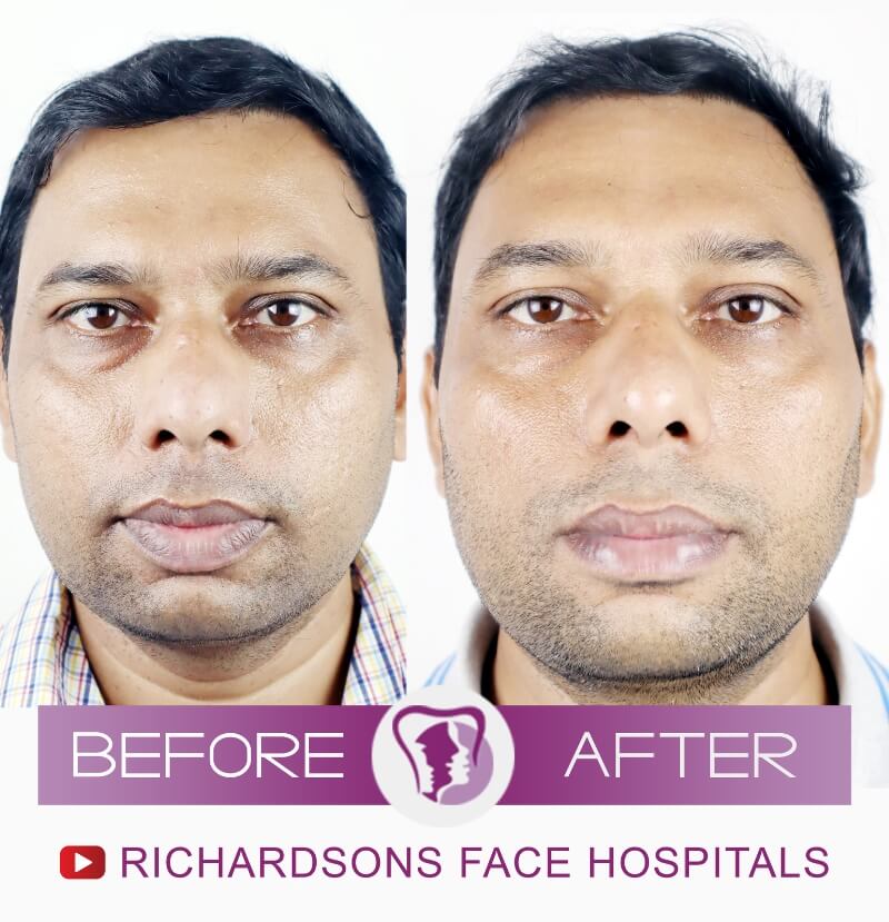 Sandip Lip Reduction Surgery