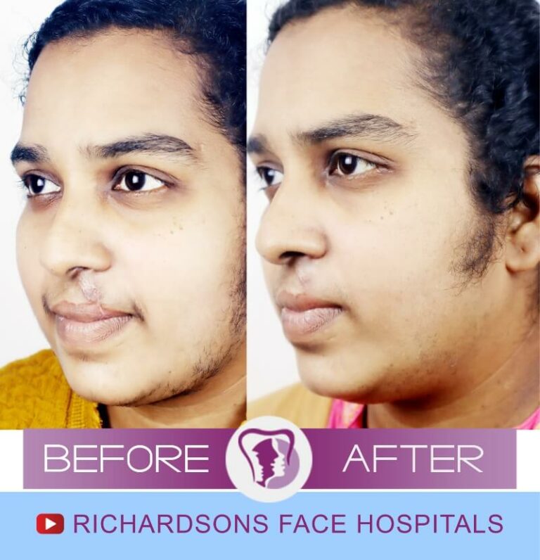 Scar Removal Surgery Photos Richardsons Hospital