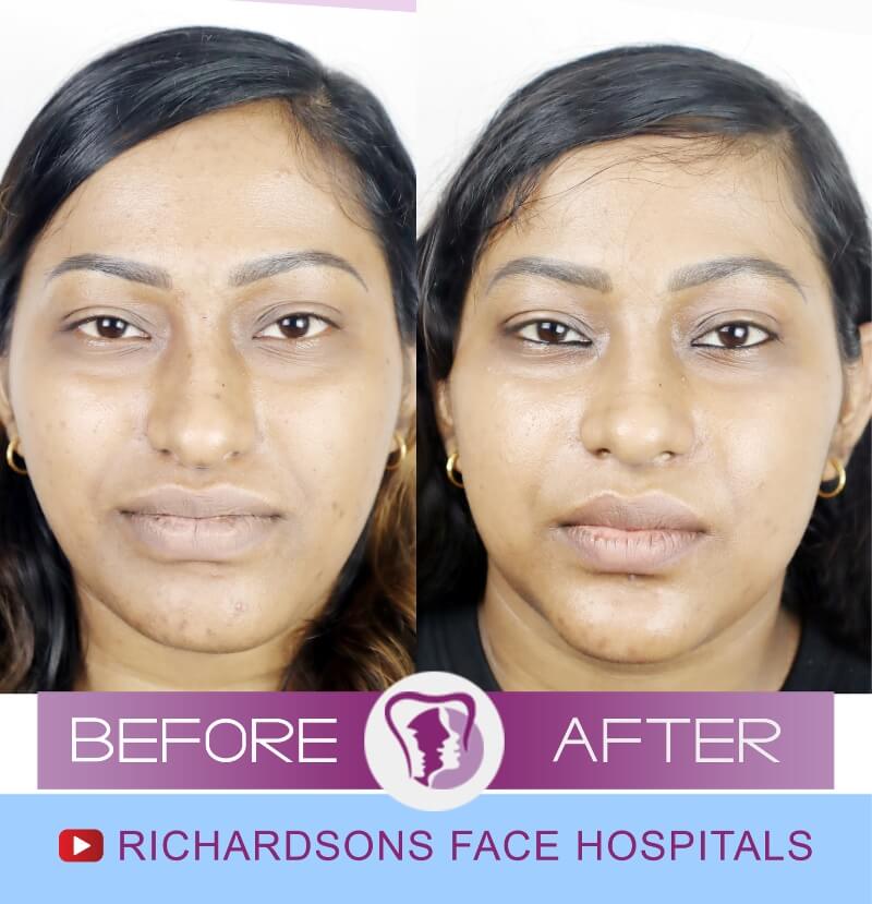 Shilpa Nose Surgery