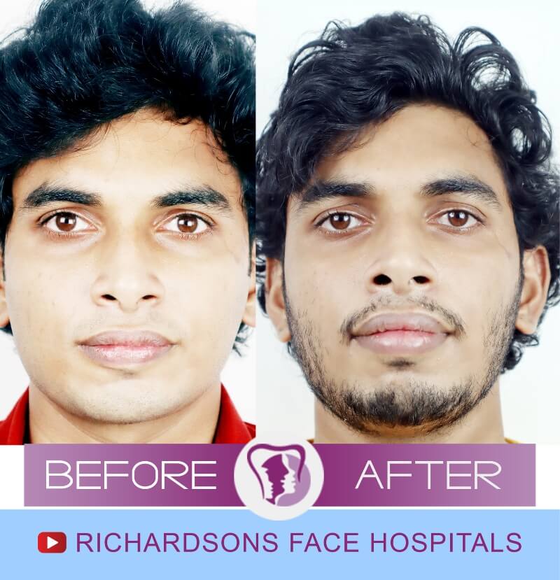 Sidharthan Lip Revision Surgery