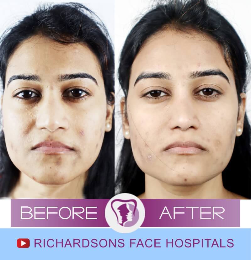 http://Swetha%20Nose%20Surgery
