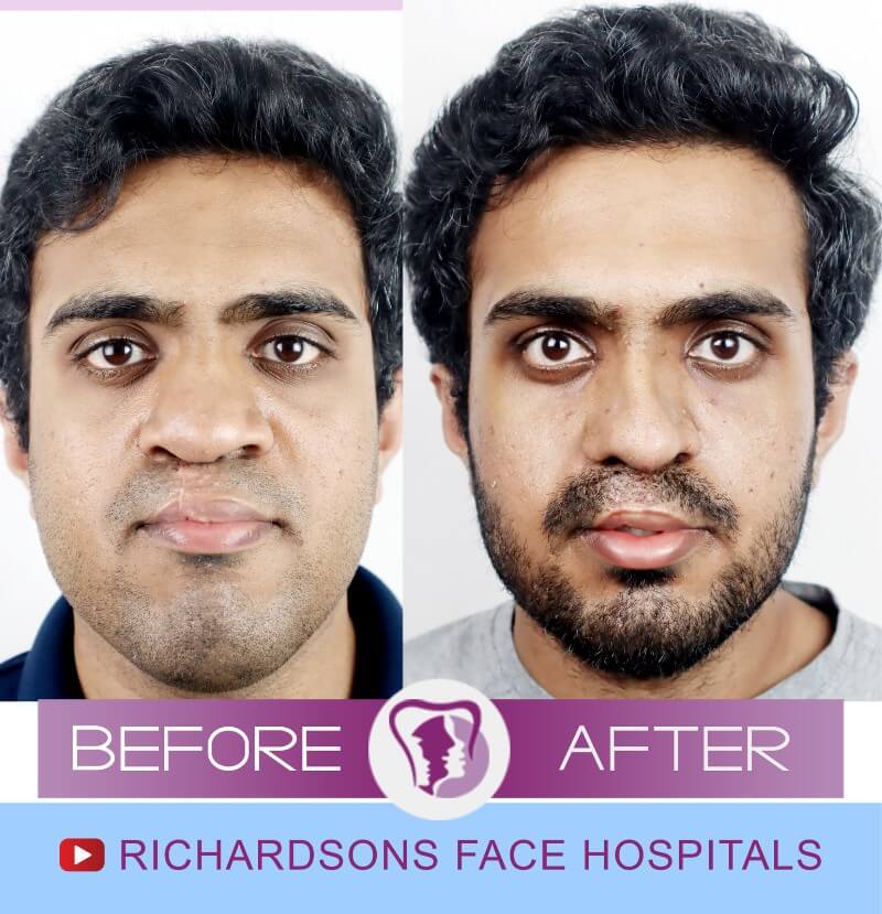 Venkateswara Cleft Lip Palate Surgery