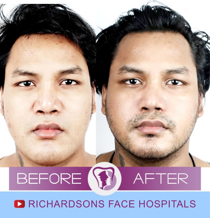 Vikas Raj Rhinoplasty Surgery