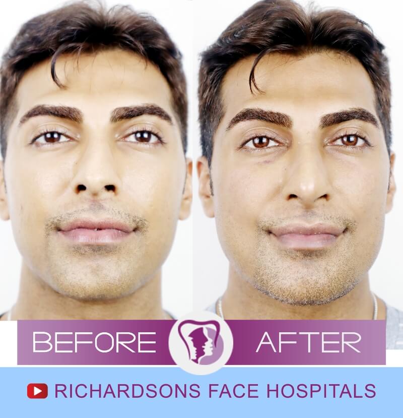 Abdul Face Makeover Surgery