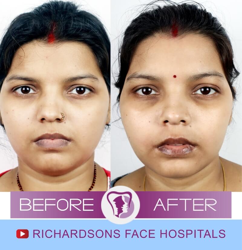 Aneeta Rhinoplasty Surgery