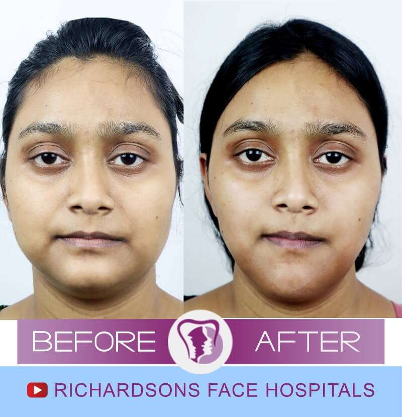 Anju Khatun Genioplasty Surgery