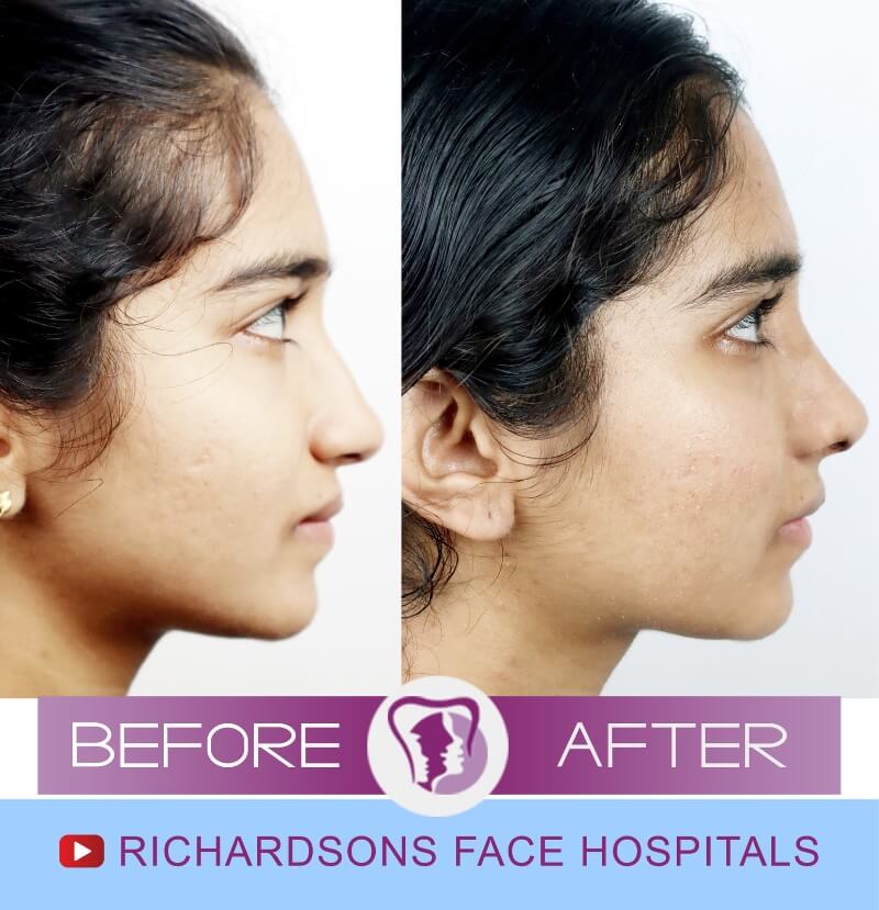 Archana Nose Surgery