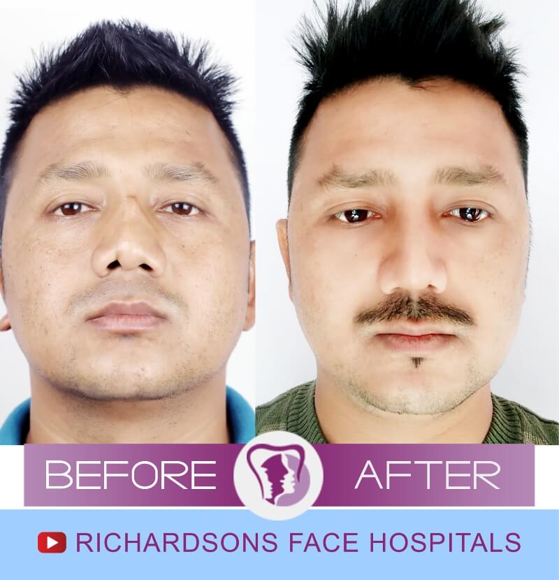 Balbir Singh Nose Surgery