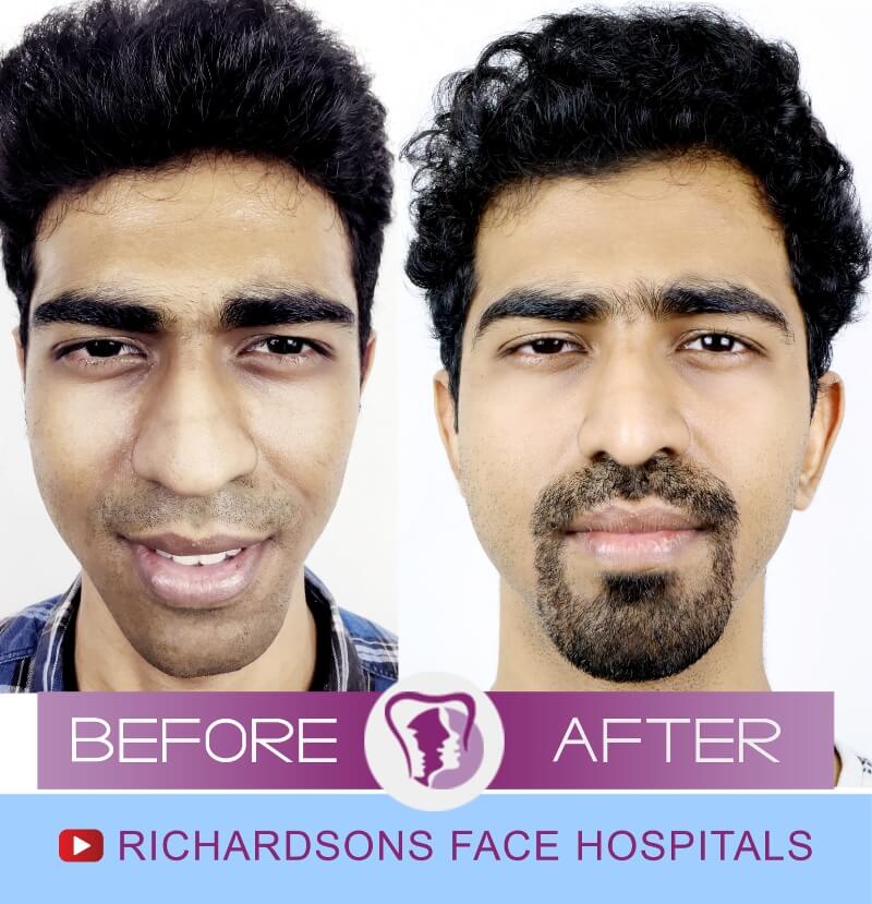 Bharath Sai Facial Asymmetry Surgery