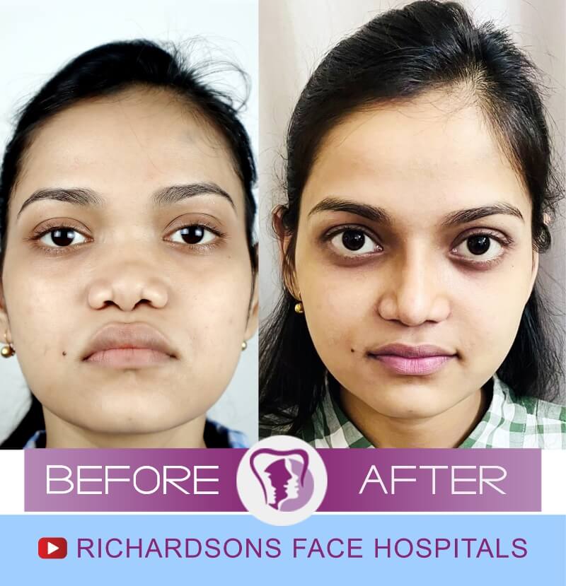 Chitra Nose Surgery