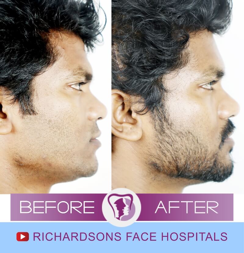 Facial Asymmetry Surgery Praveen