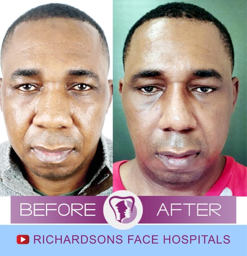 Felix Nose Surgery