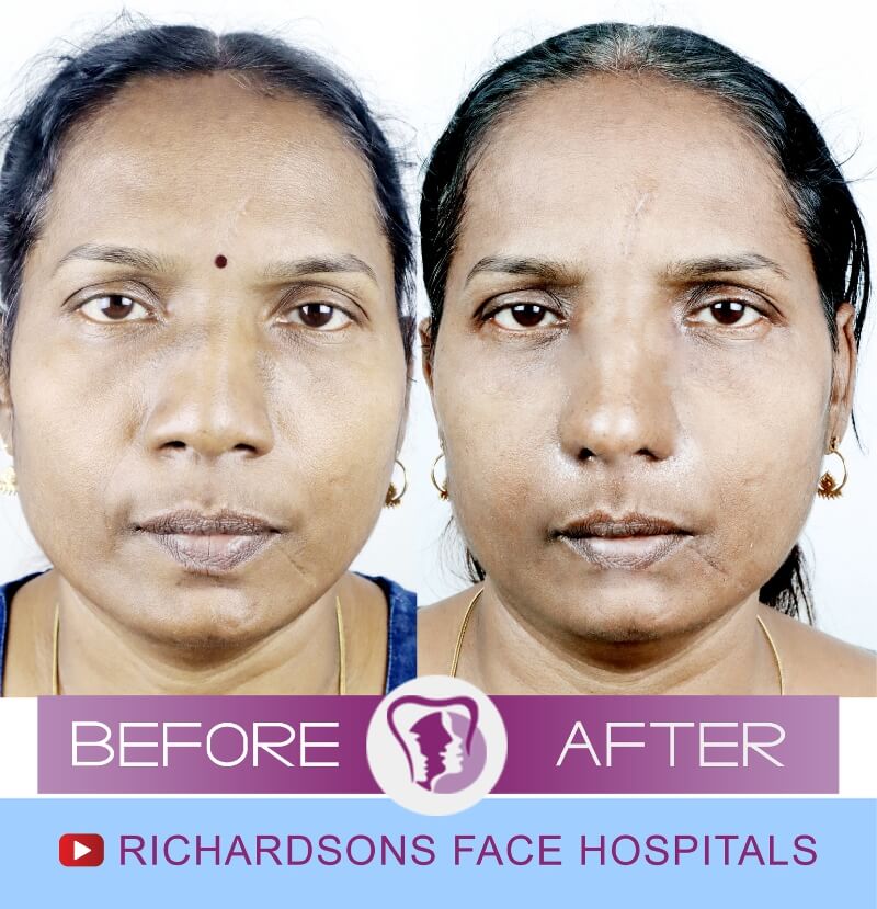 Gayathri Rhinoplasty Surgery
