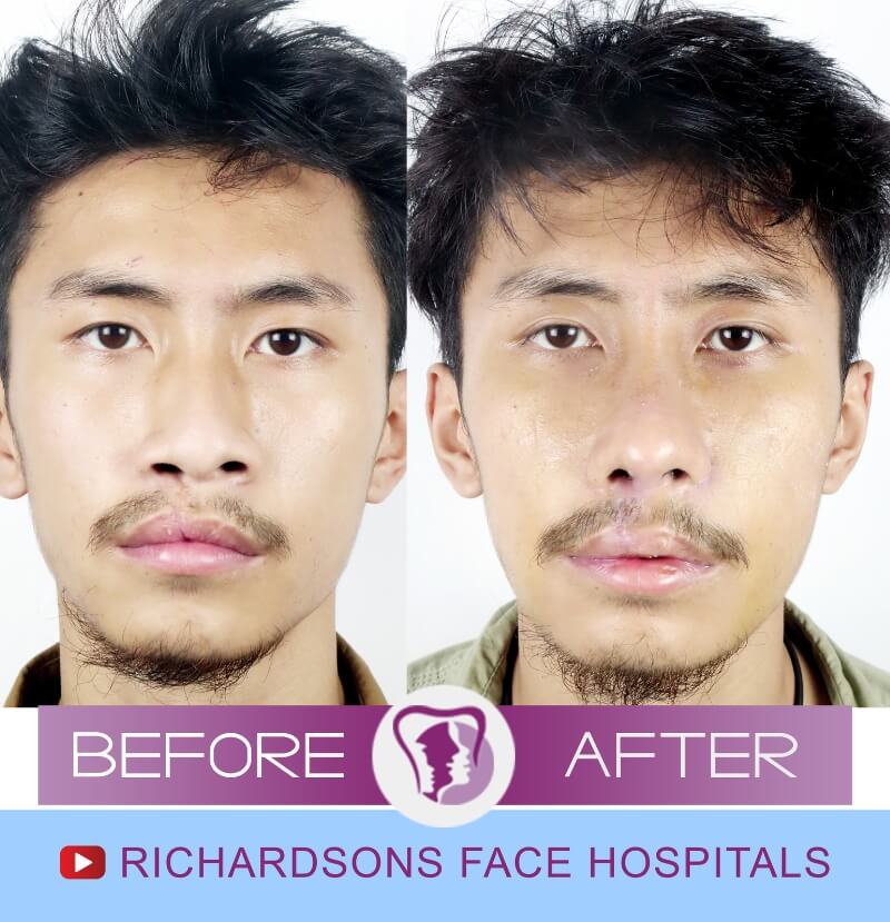 Lip Revision Surgery