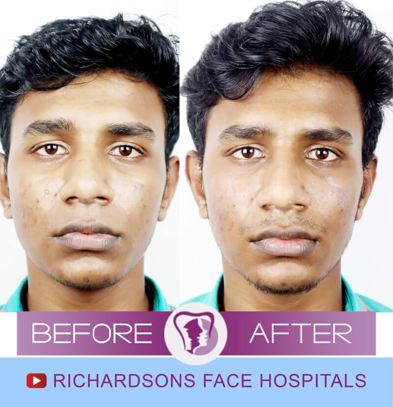 Pranav Sankar Rhinoplasty Surgery