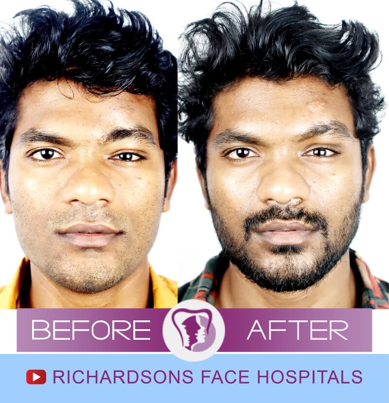 Praveen Facial Asymmetry Surgery