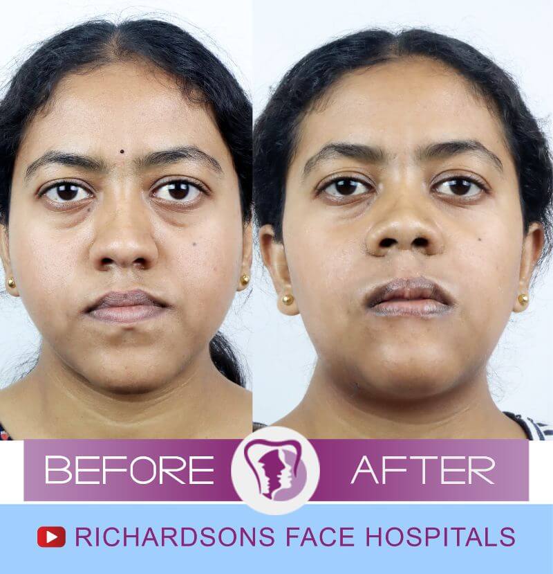 Geetha bi jaw surgery
