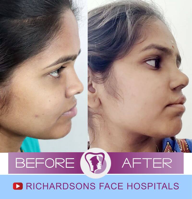 Priyadharshini lip revision surgery