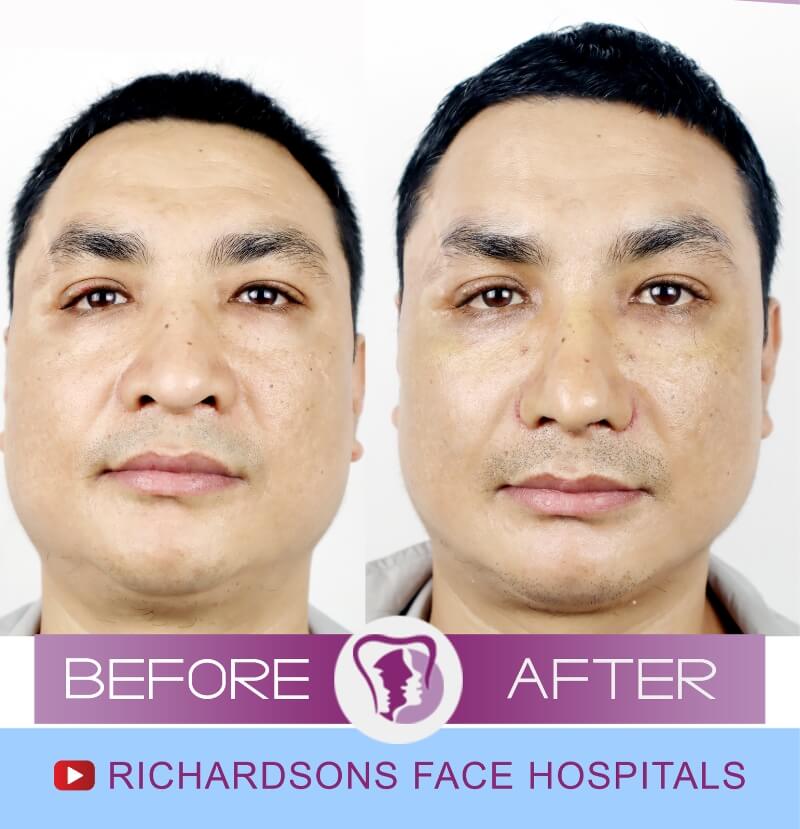 Raju shrestha nose surgery