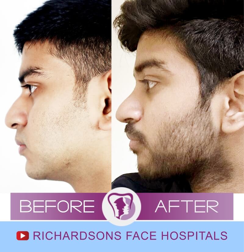 Ronesh before after nose surgery