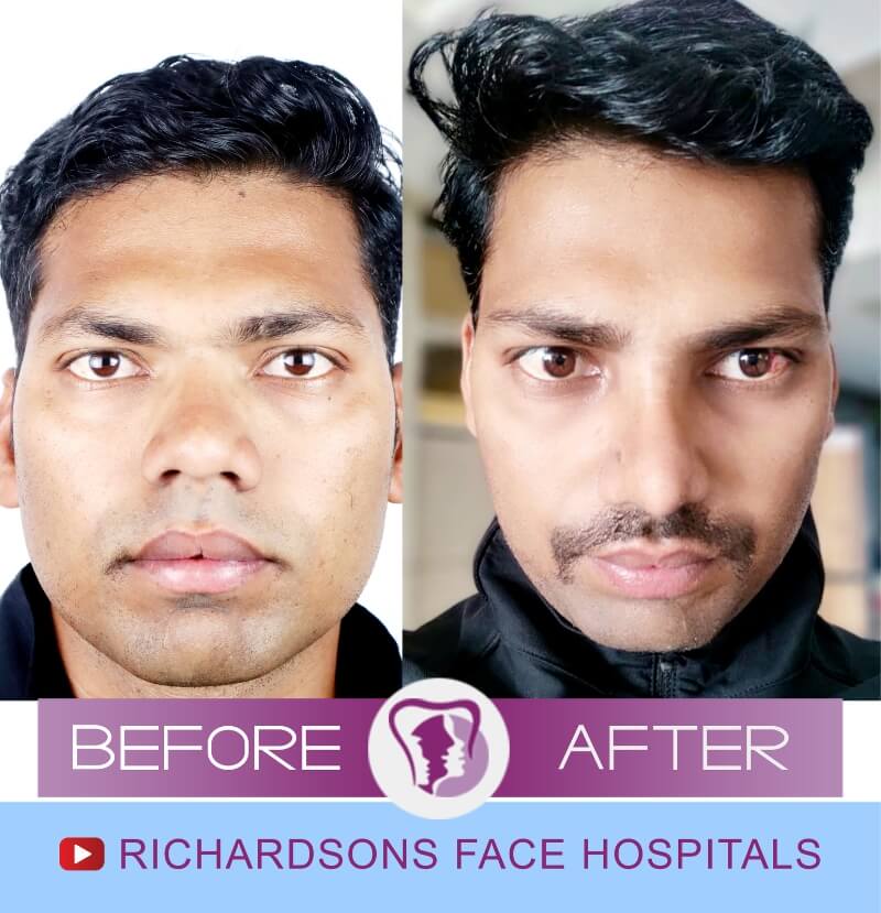 Sagar before after nose surgery