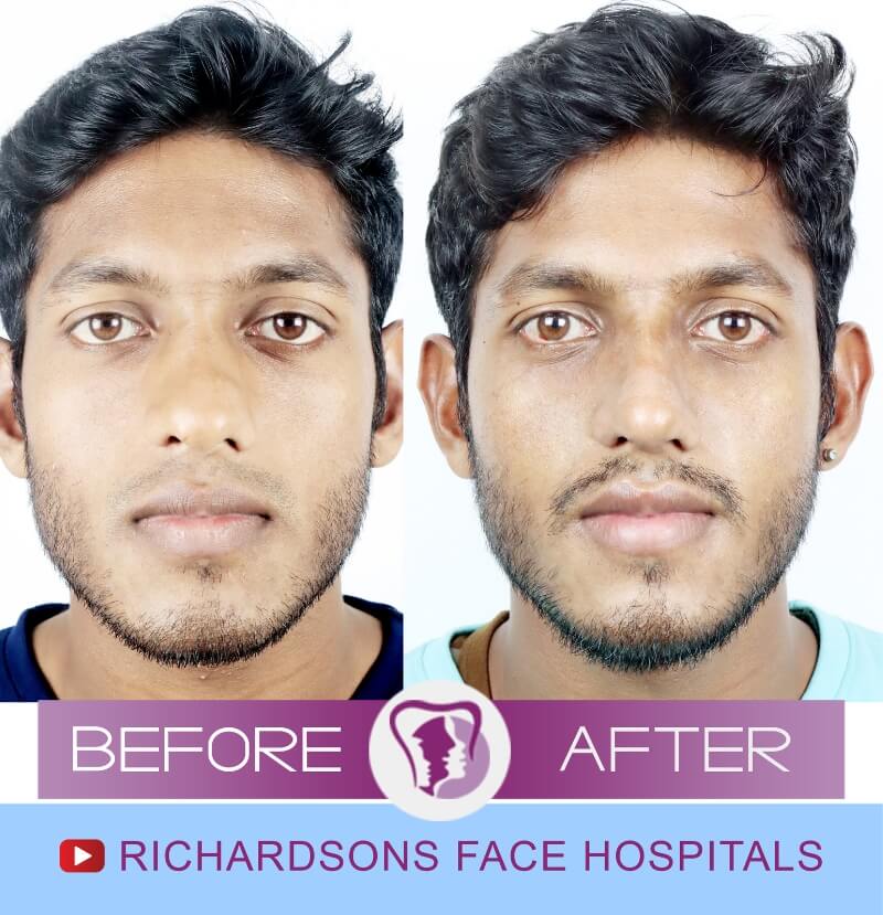 Vishnu nose surgery