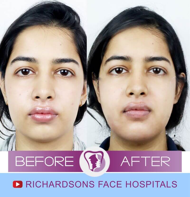 anusha before after chin surgery