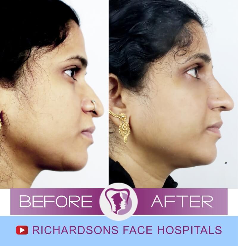 chandini nose surgery side view