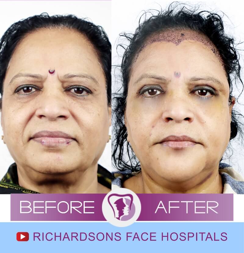 http://chandra%20before%20after%20nose%20surgery