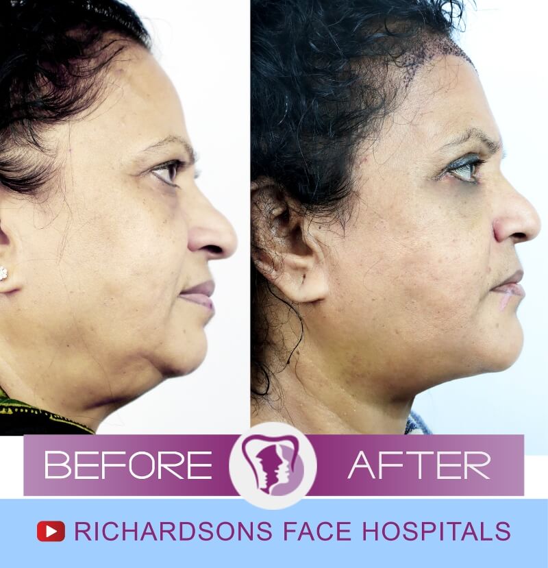 chandra nose surgery side view